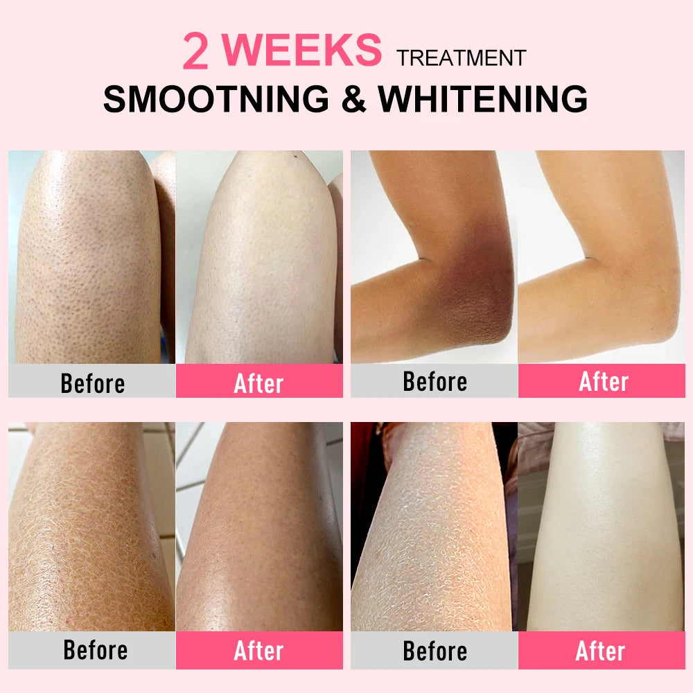 Body Cream Chicken Skin Removal Treatment Keratosis Pilaris Lotion Rough Bumpy Pore Spots Care Moisturizer Whitening Creams 60g